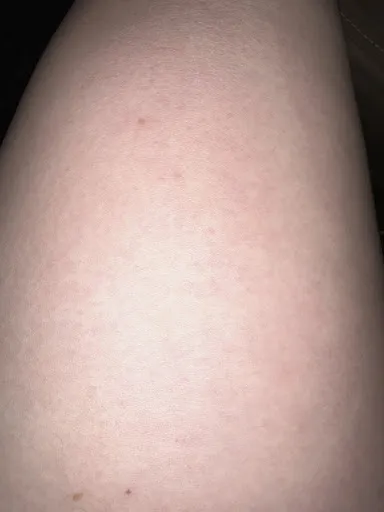 SIA SkinCenter- Epilare definitiva laser