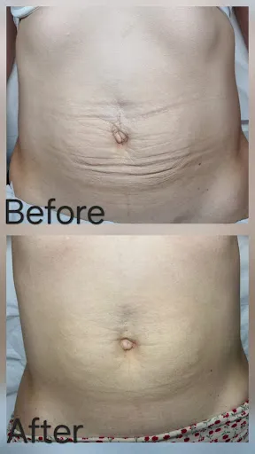 MBM STUDIO Ploiești | Tratamente Faciale (Dermapen, Microneedling, Plasma, Hifu, Tratamente Păr, Scalp, Epilare Definitivă