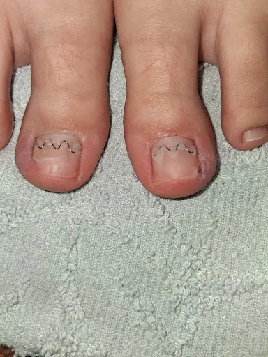 Pedichiură medicală Ploiești - Podologie